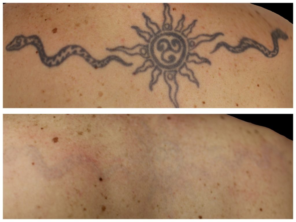 borrar tatuaje laser antes y despues