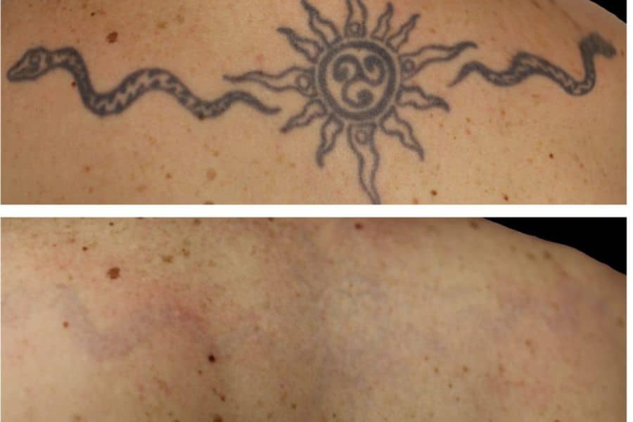 Para llevar leyendo Destruir Tatuajes Borrados Con Láser Antes Y Después | Fotomedicina