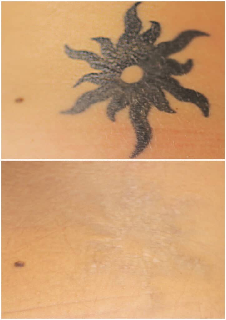 tatto borrado laser imagen antes y despues