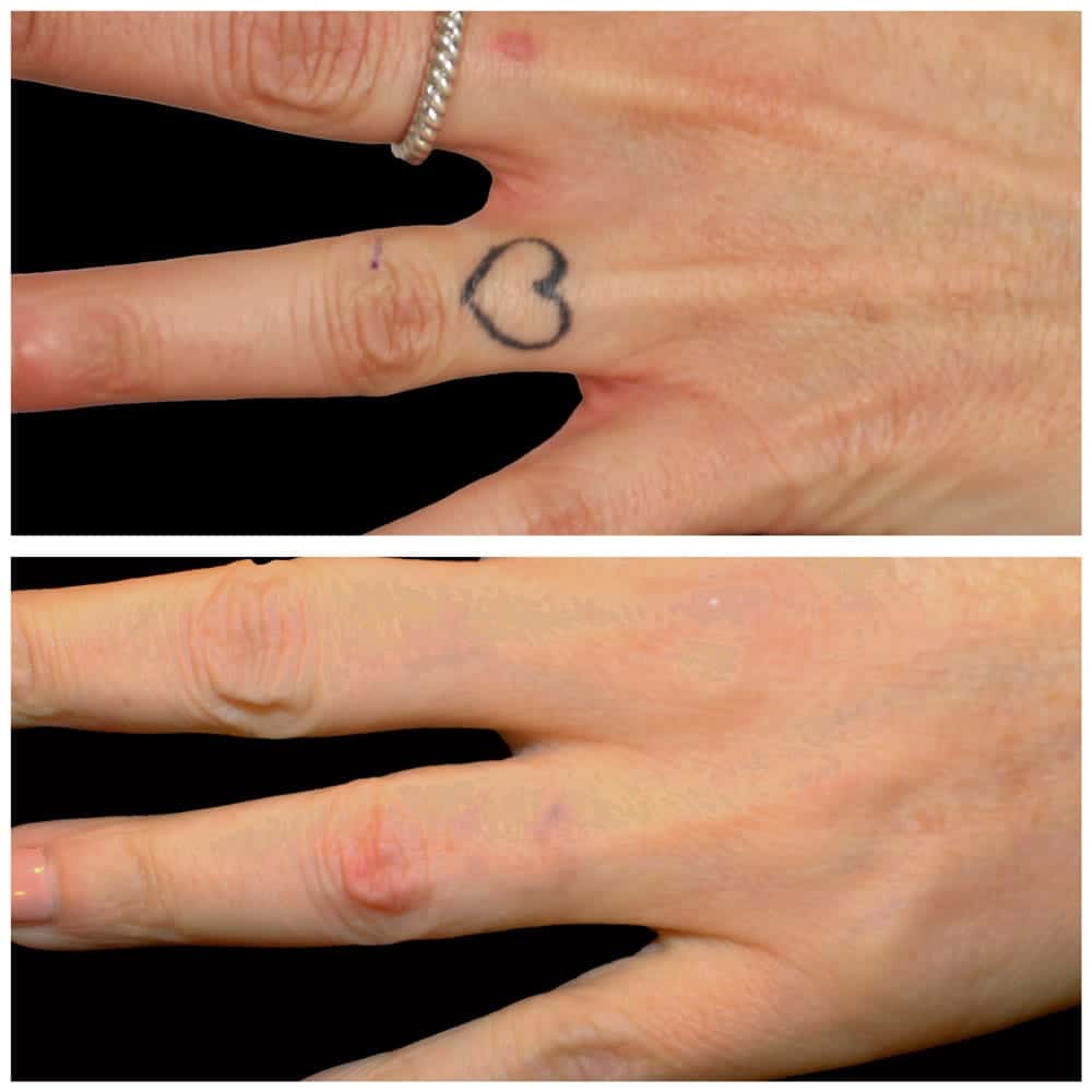 tatuajes borrados con laser antes y despues