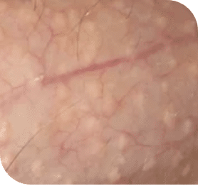 manchas de fordyce en la piel