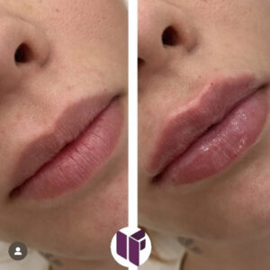 antes y despues labios acido hialuronico