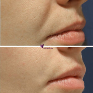 labios acido hialuronico antes y despues