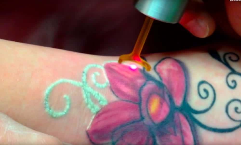peligroso eliminar un tatuaje