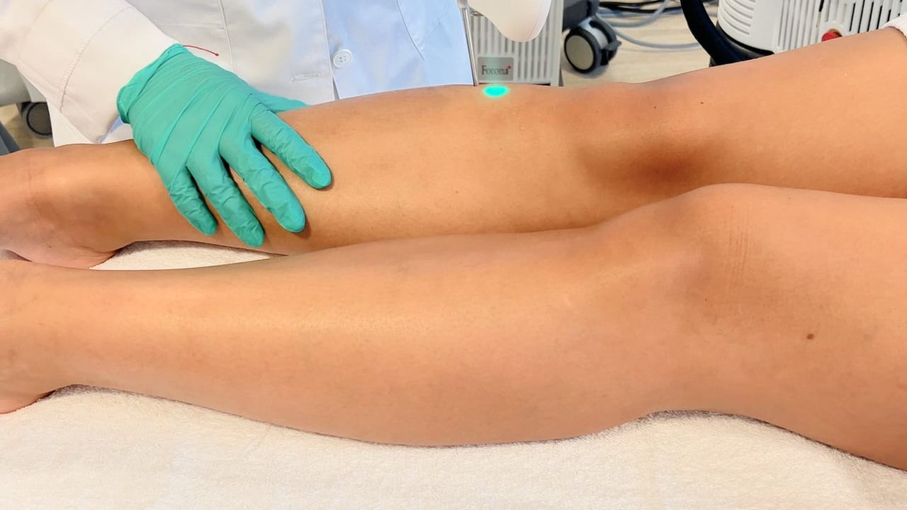 depilacion laser piernas